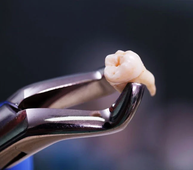 Klinika Dental Clinic_Tooth Extraction