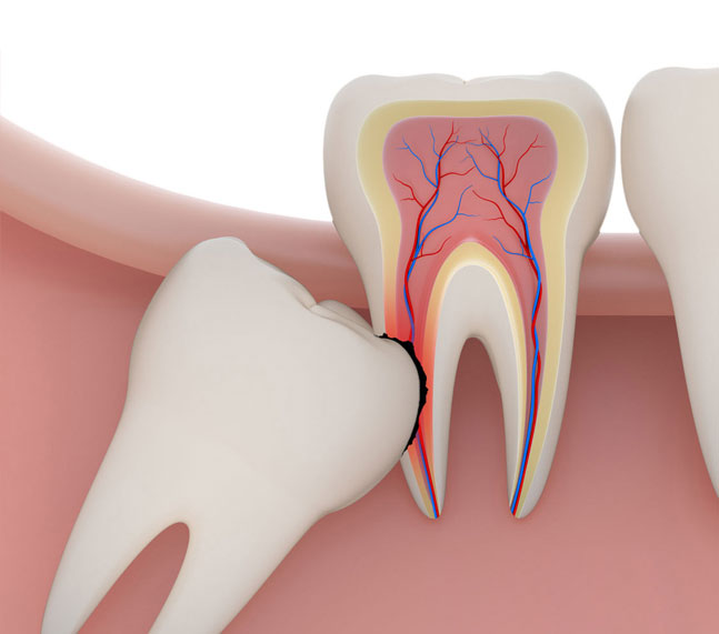 Klinika Dental Clinic_Wisdom Tooth Removal